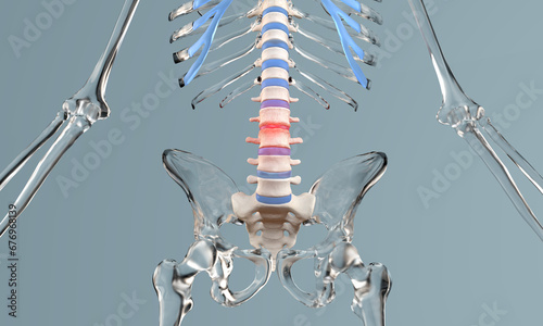 Stenosis of the lumbar spine in glass skeleton