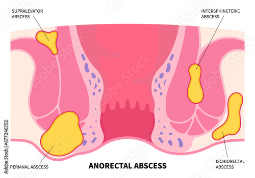 The hemorrhoids or colorectal fissure cancer with bleeding and infection after surgery