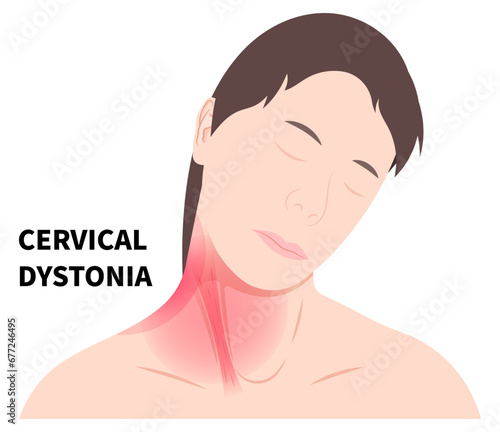 Women Neck muscle stiffness pain in adults or baby with chronic cervical dystonia disorder and the Torticollis of occupational therapy exercise