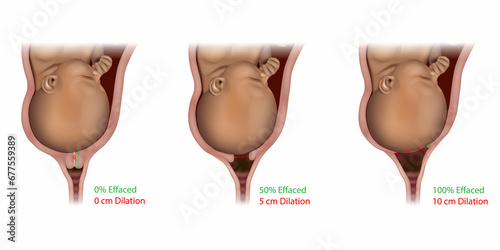 Cervical Effacement and Dilation During Delivery. Labor or delivery. Cervix changes from not effaced and dilated to fully effaced and totally
