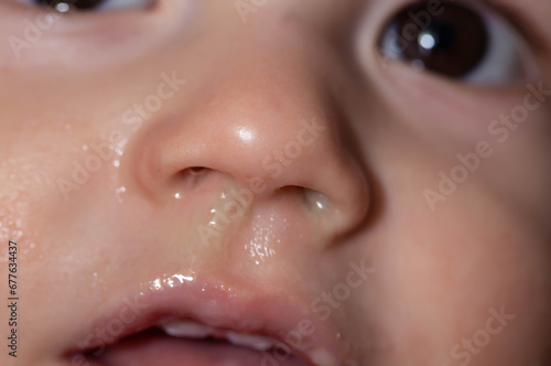 Yellow snot from a child s nose, close-up. Sinus infections, colds and virus. Chronic runny nose, adenoviruses