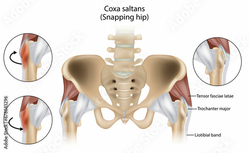 Coxa Saltans or Snapping Hip Snapping Hip Syndrome also referred to as dancer hip.