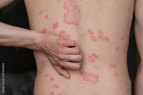 Psoriasis Vulgaris, skin patches are typically red, itchy, and scaly. Papules of chronic psoriasis vulgaris on male hand, back and body. Genetic immune disease. Detail of psoriatic skin disease 