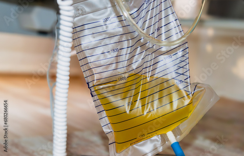 Urine bag with full of pee and pee catheter hang under patient bed. 