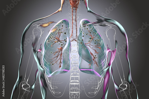 Human lungs with silicosis, 3D illustration