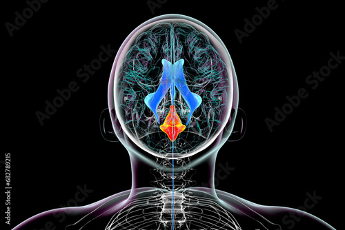 Enlargement of the fourth brain ventricle, 3D illustration