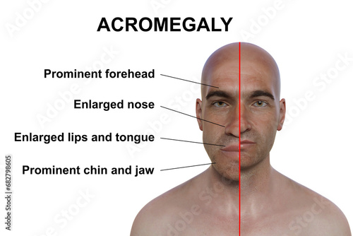 Acromegaly in a man, and the same healthy man, 3D illustration