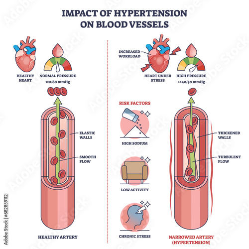 Impact of hypertension on blood vessels with high pressure outline diagram. Labeled educational scheme with healthy vs narrowed artery and turbulent flow vector illustration. Medical risk factors.