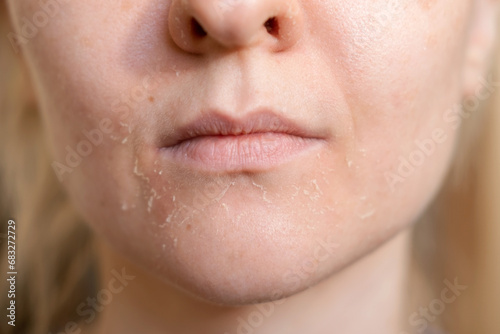 The woman skin flakes off at the mouth. Dry skin. Face skin irritation after peeling, after cold windy weather