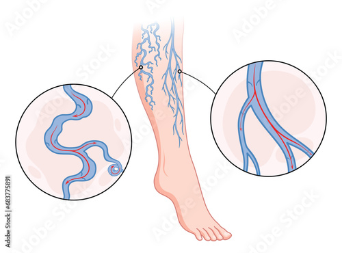 Varicose veins. Blue blood vessel visible through the skin, abnormally swollen leg. Vascular disease diagnostic and treatment. Venous insufficiency medical disease
