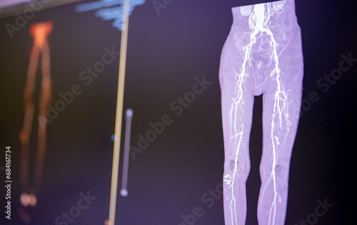 CT image of chronic arterial occlusion in Superficial femoral -popliteal artery segment. Fem-pop occlusion. 