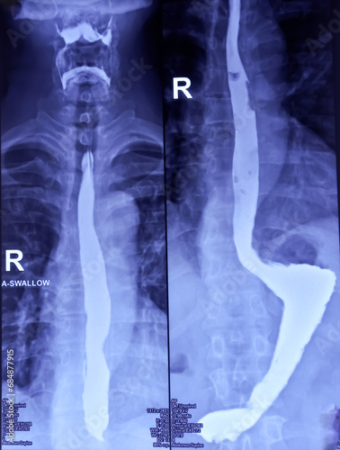 Barium swallow of oesophagus examination x-ray. showing upper digestive system. Oesophagus, mucosal pattern of oesophagus, Normal findings.