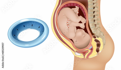 Gynecological and obstetric pessary. Cervical pessary in pregnant women with a short cervix. Modeling of effective positioning of Arabin cerclage pessary in women at high risk of preterm birth.