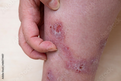 rash, hives, itchy skin on leg, inflammation and Medical Allergies, disease female patient, Dermatology Issues, skin problems on general physical, emotional well-being