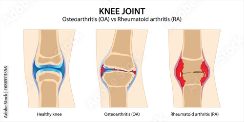 Knee Joint Osteoarthritis vs Rheumatoid arthritis