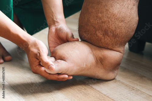 Doctor examining patient foot that suffering from filariasis or lymphatic filariasis