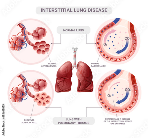 Healthy and pulmonary fibrosis alveoli. Vector illustration isolated on white background