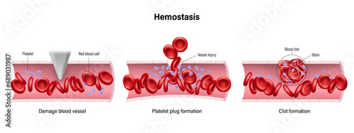 Hemostasis vector. Wound Healing Process Stages. Blood clotting. 