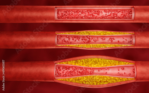 Set of Hyperlipidemia or arteriosclerosis. Blocked artery concept and human blood vessel as a disease with cholesterol fat buildup clogging. Clogged arteries, Cholesterol plaque in the artery