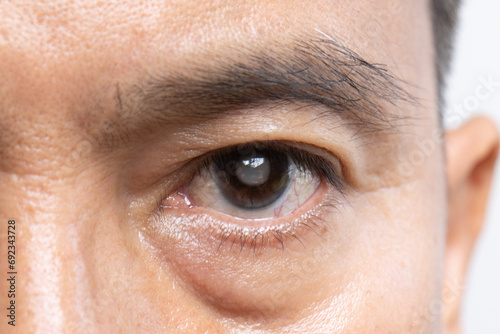 Senior man has cataracts. Generally, cataracts are common in older people.