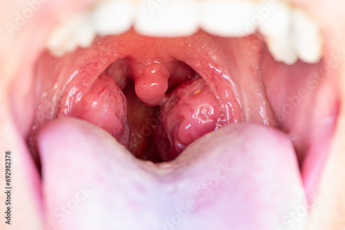 The child is a patient with large red glands. Tonsils in close-up in the mouth. Closeup view of open mouth with tonsils