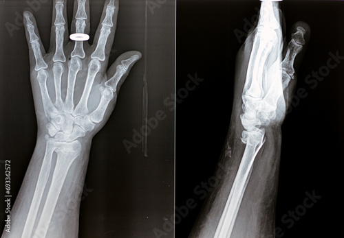 Colles' fracture of an old female, a type of fracture of the distal forearm in which the broken end of the radius is bent backwards, as a result of a fall on an outstretched hand with osteoporosis