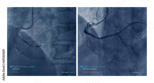 Male, 68 years old, chest pain for 7 hours. Coronary angiography suggests occlusion of the distal right coronary artery. The patient was successfully placed with a coronary stent.