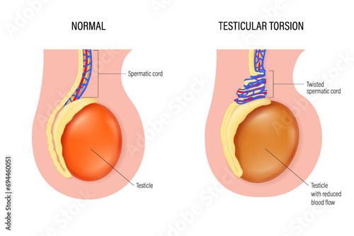 Testicular torsion vector. Comparison of normal and Testicular torsion. Testicular disease. Male reproductive system.