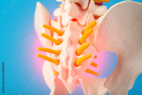 Model of the human spine, section of the inflamed coccyx with nerves on a blue background. Pinched nerve due to problems with the spine. Spondylolisthesis and spinal stenosis,
