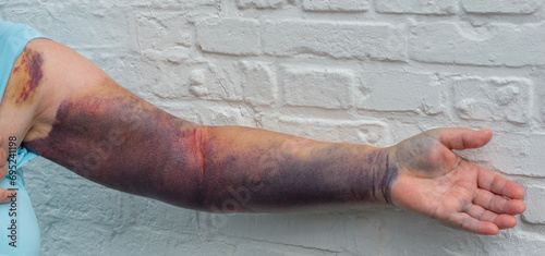 Hämatom Bluterguss am ganzen Arm durch ein Ellenbogenbruch 