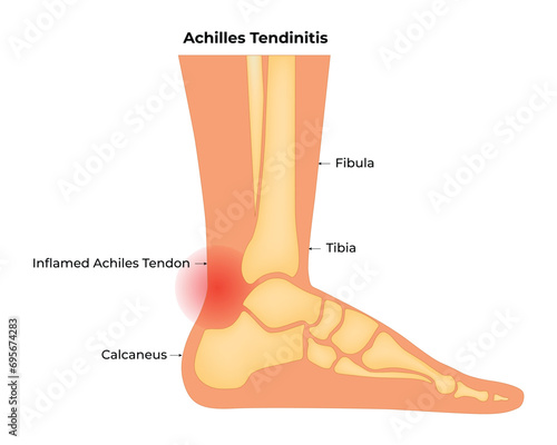 Achilles Tendinitis Science Design Vector Illustration