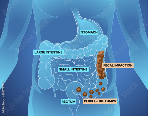 Bowel obstruction. Infographic. Healthcare illustration. Vector illustration. 