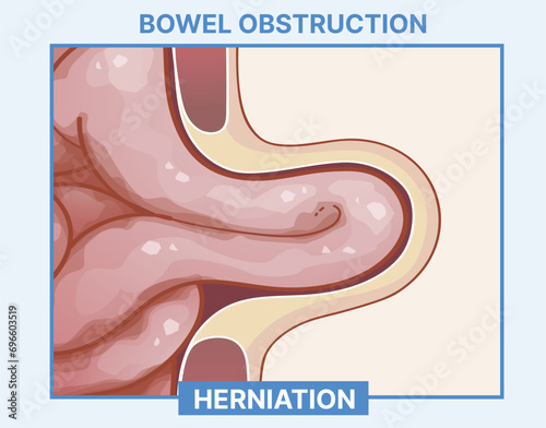 Bowel obstruction. Digestive system hernia. Infographic. Healthcare illustration. Vector illustration. 
