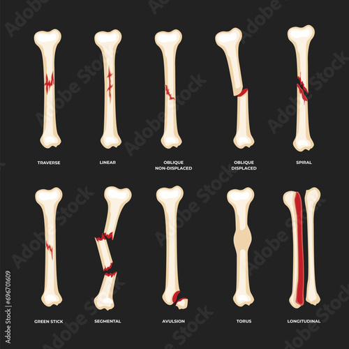 Set of different types of bone fracture collection, Diagram of leg fracture in different stages for infographic biology education school, Femur Bones, human anatomy poster.