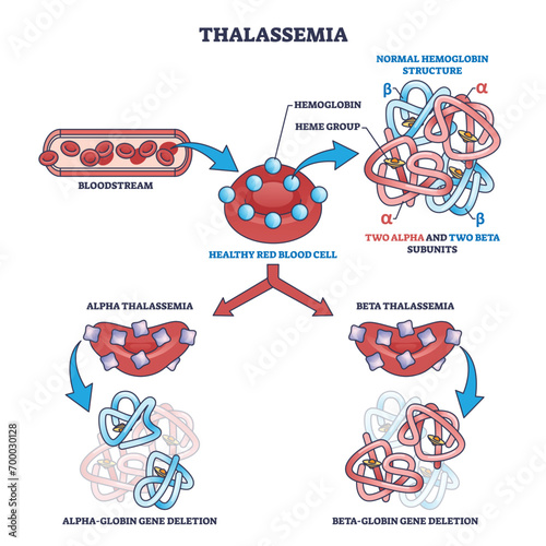 Thalassemia blood disease as hemoglobin structure deletion outline diagram. Labeled educational scheme with alpha and beta globin subunits disorder vector illustration. Medical illness explanation.