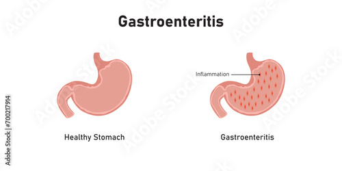 Gastroenteritis Disease Scientific Design. Vector Illustration.