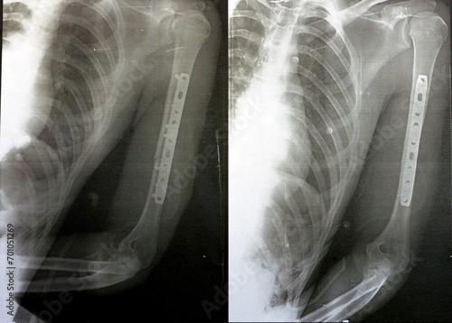 Plain x ray showing transverse midshaft left humerus fracture caused by a direct trauma in a car accident, managed by open reduction and internal fixation with plates and screws, selective focus