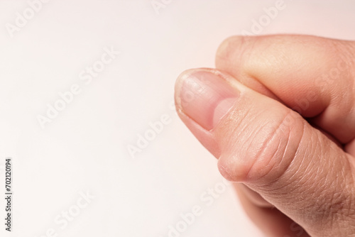 Hygroma (Ganglion cyst) of the thumb joint. Selective focus.