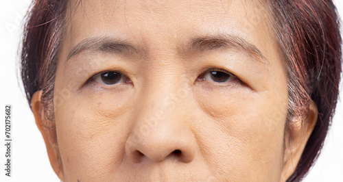 The ptosis or droopy eyelids in asian senior woman.