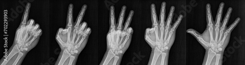 Film xray x-ray or radiograph of a hand and fingers showing the numbers one through five 1-5. One, two, three, four five in gestural language, manual communication, or signing aka sign language