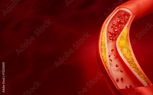 Hyperlipidemia or arteriosclerosis. Blocked artery concept and human blood vessel as a disease with cholesterol fat buildup clogging. Clogged arteries, Cholesterol plaque in the artery. 3D Rendering