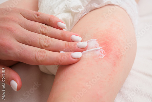 The mother is treating her child's pimple allergy with a cream. The woman is gently applying cream on the irritated skin of her baby's leg.