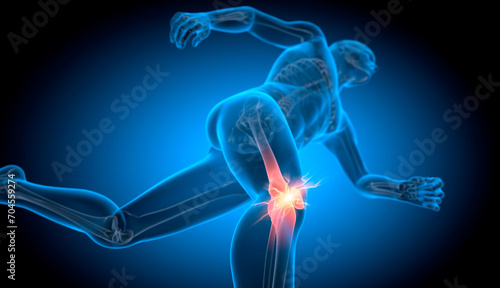 Running man with pain in knee joint - 3D illustration