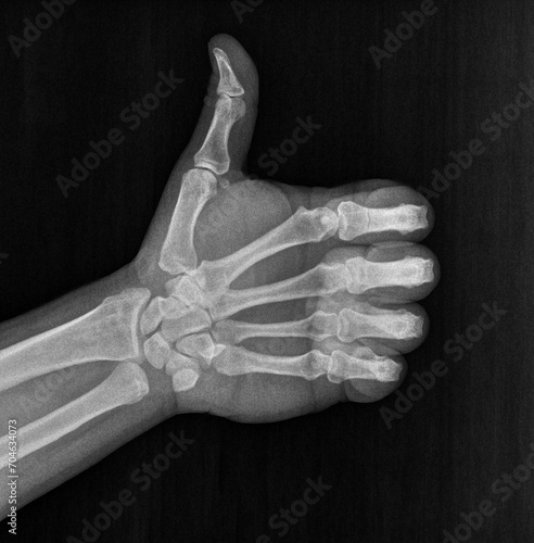 Film xray x-ray or radiograph of a thumb up associated with agreement, approval, confirmation or positivity in gestural language, manual communication, or signing aka sign language