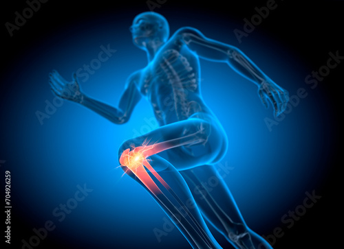 Running man with pain in knee joint - 3D illustration