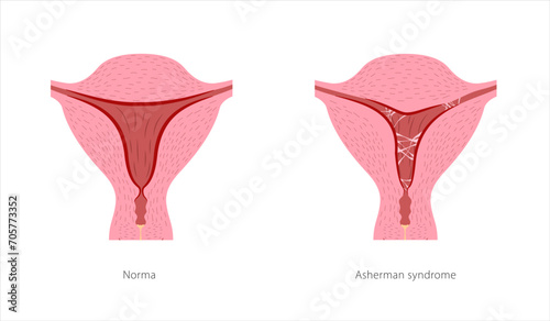 Asherman syndrome female reproductive system. Cross section of uterus with ashesions. Scar tissue in uterine cavity and normal healthy organ.