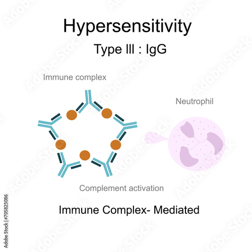 The diagram of Hypersensitivity type lll : Immune complex -Mediated that shows the Immune complex of Antigens and Antibodies indued complement activation , neutrophil and Inflammation Process.