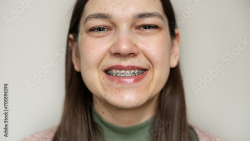 Metal braces on teeth. Orthodontic dental care concept. Woman's smile with braces.