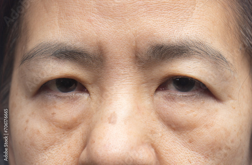 Senior asian woman worry about eye bags and dark spot.