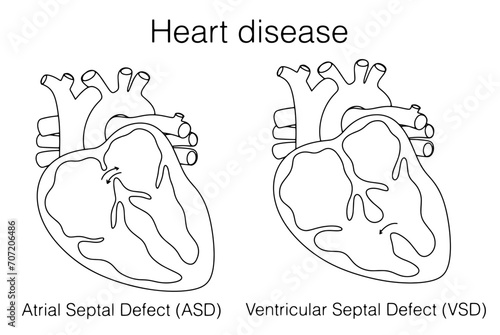 Heart. Atrial Septal Defect. Ventricular Septal Defect